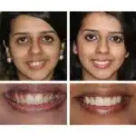 Stylo Blancheur Dent – HealthCare™ 15