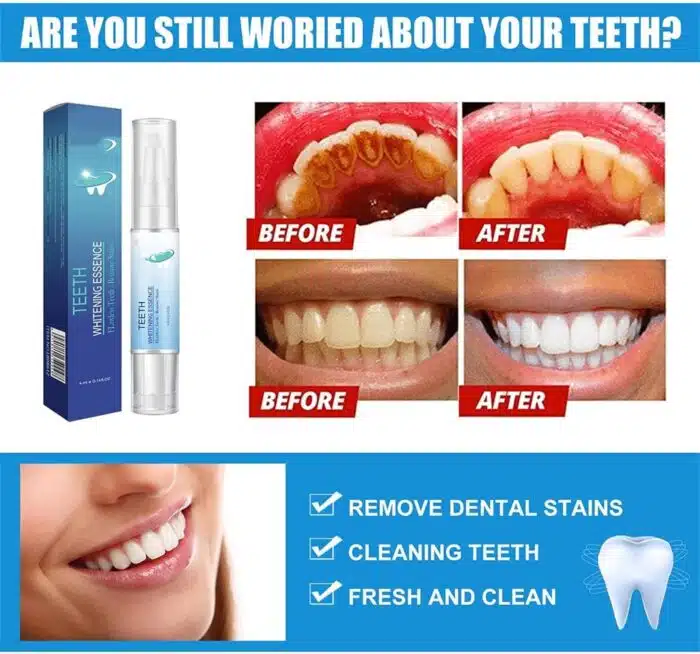 Stylo Blanchisseur de Dents - White Teeth