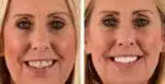 Stylo Blanchisseur de Dents - White Teeth – Image 4