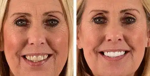 Stylo Blanchisseur de Dents - White Teeth – Image 4