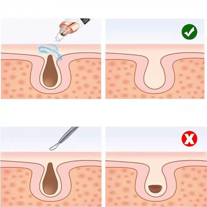 Aspirateur à Points Noirs | Nettoyeur de pores FaceCare – Image 3